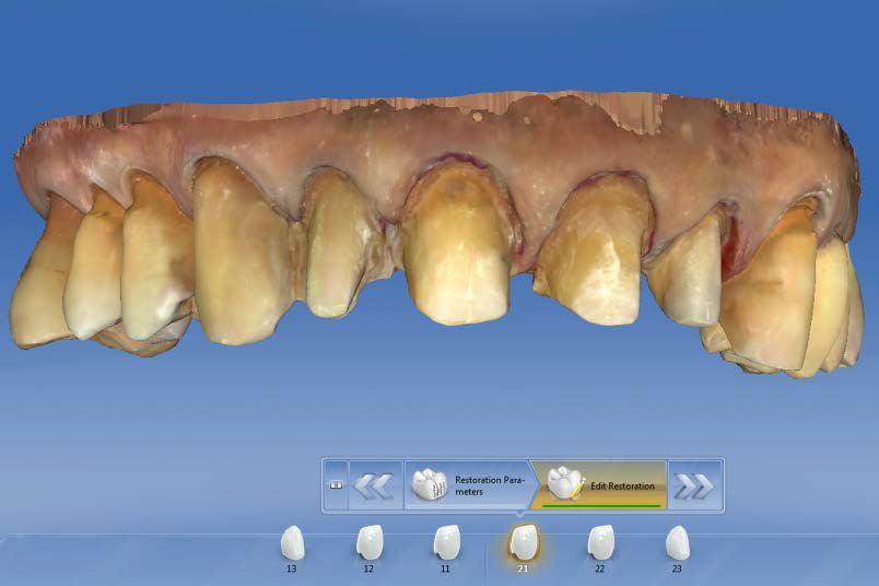CEREC AC OMNICAM ПРОСТОЕ СКАНИРОВАНИЕ БЕЗ АНТИБЛИКОВОГО СПРЕЯ 8.jpg CEREC AC OMNICAM ПРОСТОЕ СКАНИРОВАНИЕ БЕЗ АНТИБЛИКОВОГО СПРЕЯ 8.jpg